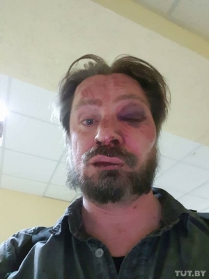 Сергея Чалого избили неизвестные. Он в больнице с переломом носа и черепно-мозговой травмой. 